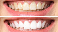 Teeth Whitening