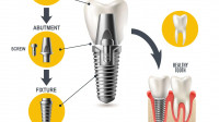 Dental Implants